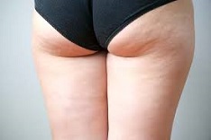 rimedi naturali cellulite 