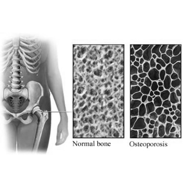terapia naturale osteoporosi