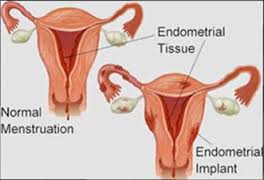 terapia naturale endometriosi