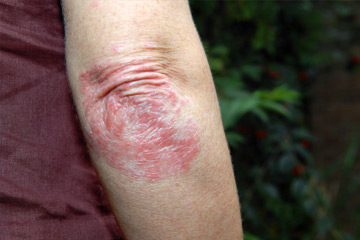terapia naturale psoriasi