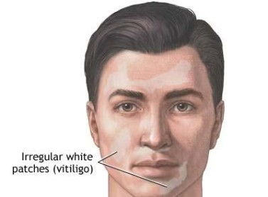 rimedi naturali vitiligine